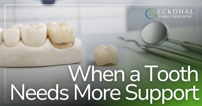 When a Tooth Needs More Support dental crowns